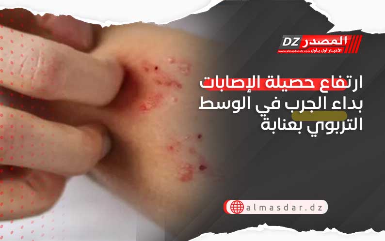 ارتفاع حصيلة الإصابات بداء الجرب في الوسط التربوي بعنابة